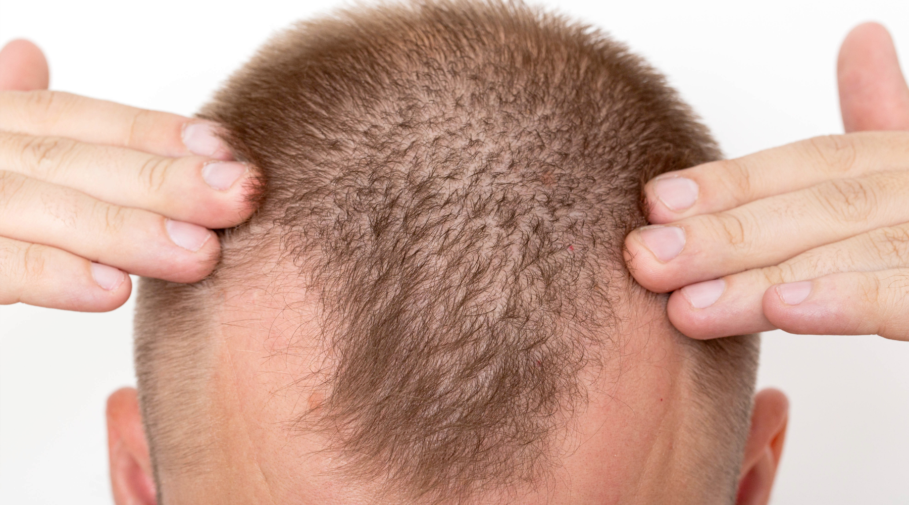 Is DHT Hair Loss Reversible  DS Healthcare Group