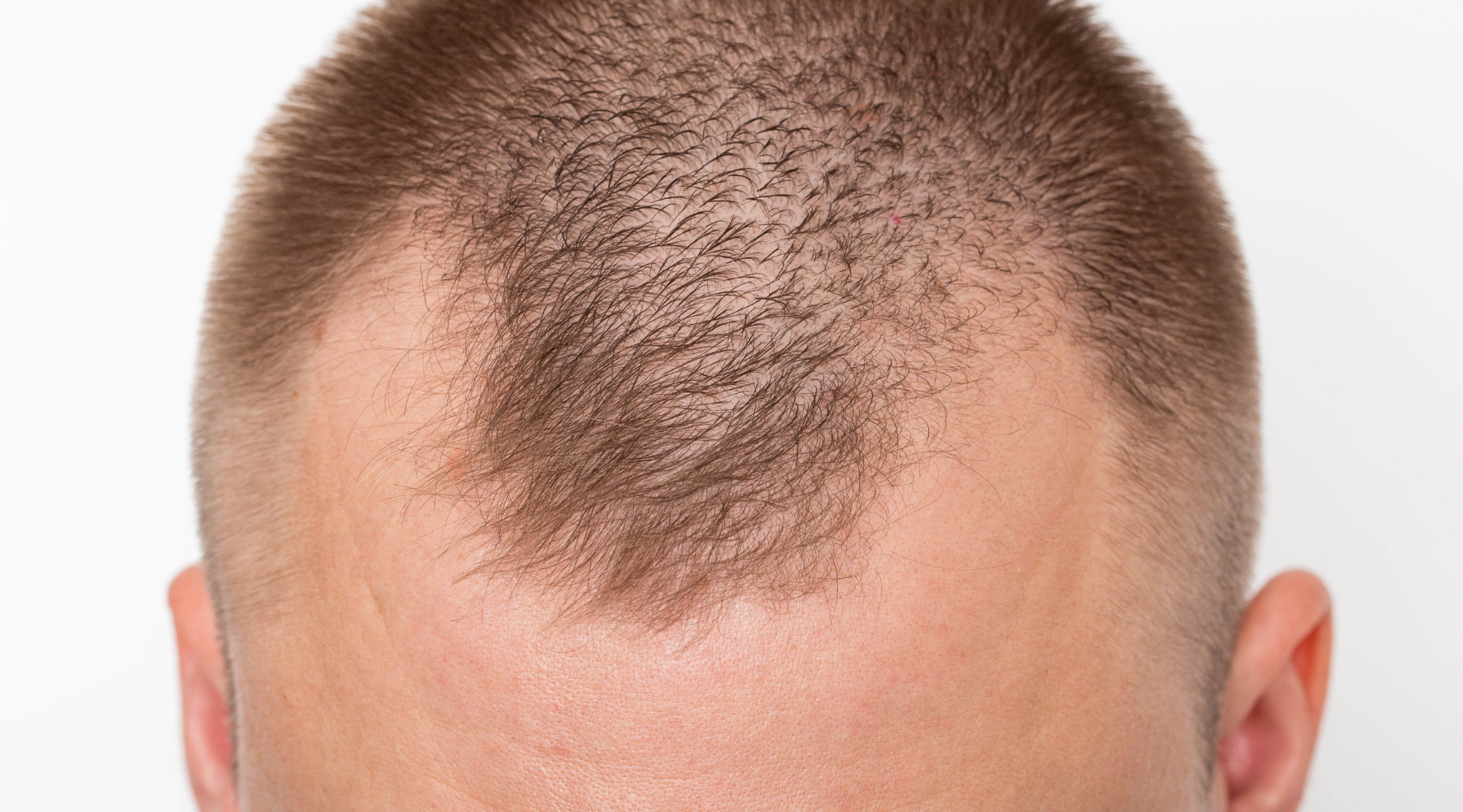 Top 10 Natural DHT Blockers to Prevents Hair Loss  Medispa