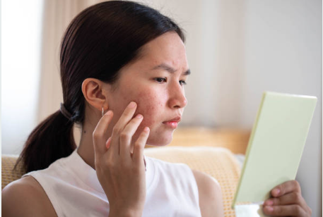 The Dark Side of Acne