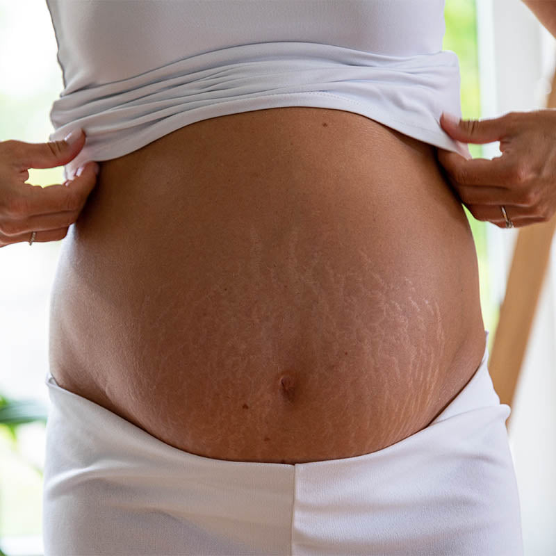 how to get rid of stretch marks in pregnancy