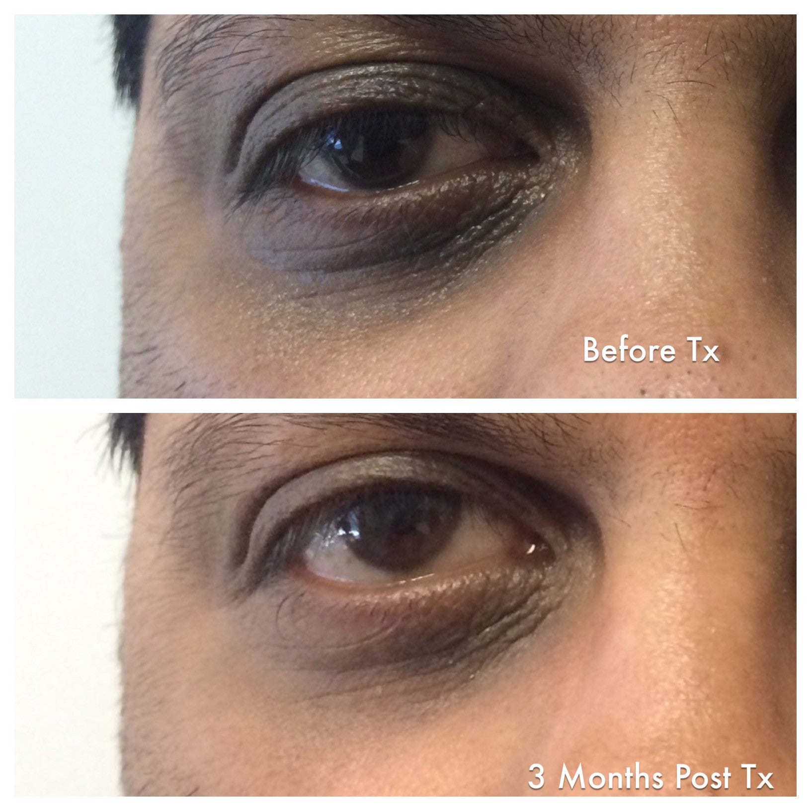 Enriched Retinol Eye Cream Before and After