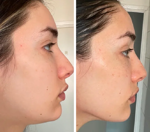 Gua Sha Before and After