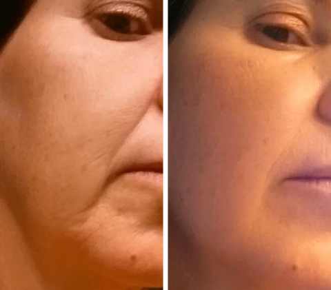 Gua Sha Before and After