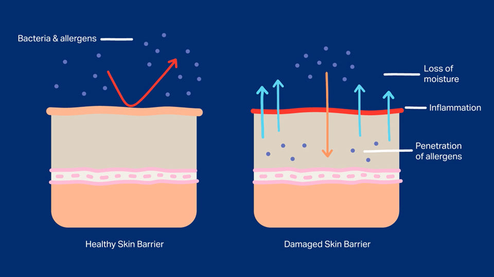 Skin Barrier - National Eczema Organization