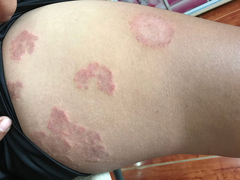Ringworm in kids: The parent's guide to symptoms and treatment