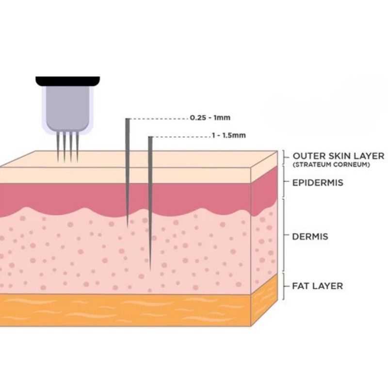 How to choose the right microneedling length