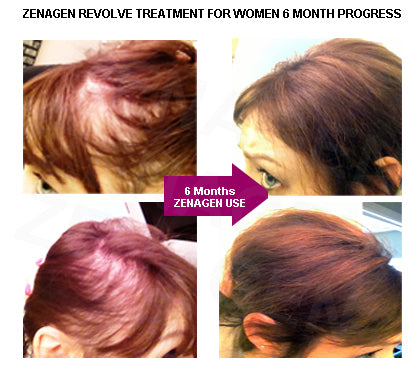 Zenagen Women's Hair Loss Before and After
