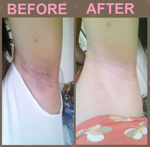 Before and After using Professional Strength Underarm whitening Cream