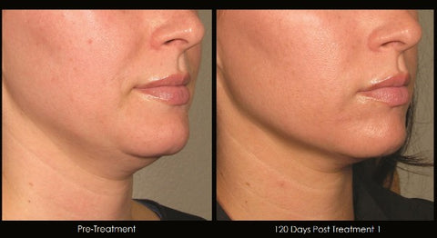 Ultherapy Before And After, Skin Tightening Treatment In Boston, Lexington and Wellesley