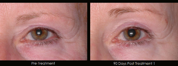 Image of a woman's eyes before ultherapy treatment and after ultherapy treatment.