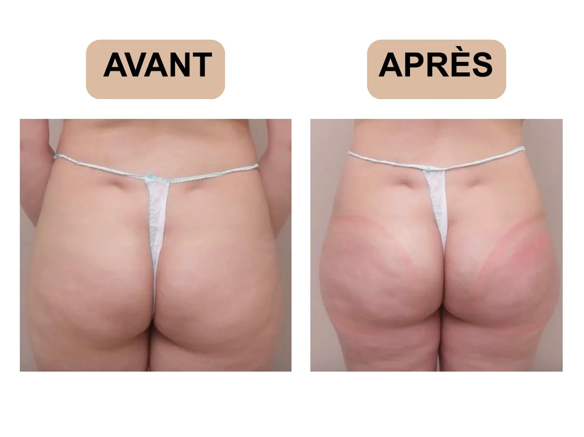 Avant-Apres-lifting-Colombien