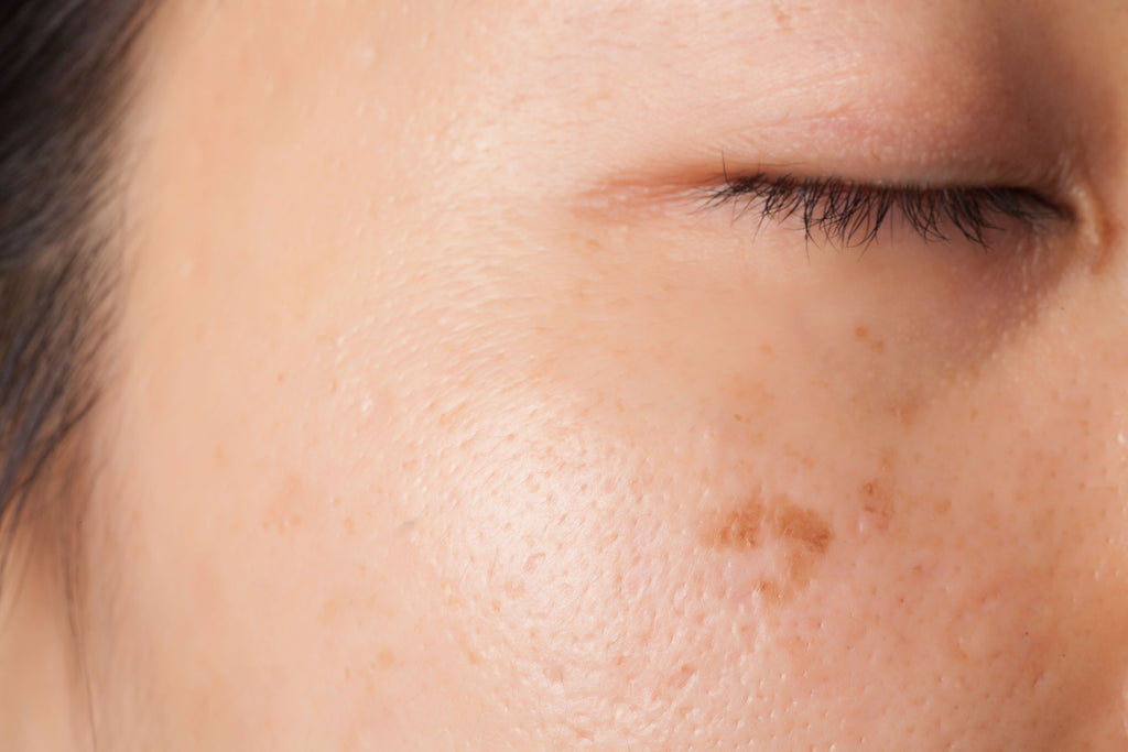 Girls skin close up of Melasma and Dark Spots