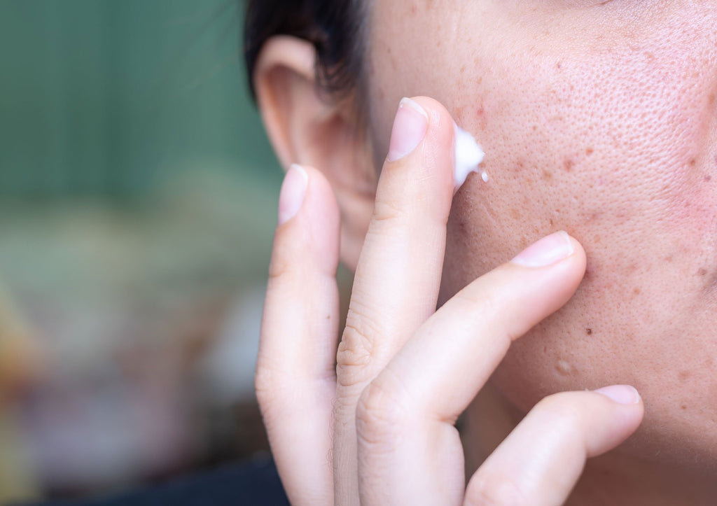 How to treat dry congested breakout prone skin