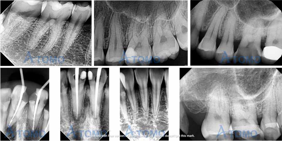 X-ray photos by i-sensor (ATOMO Dental)