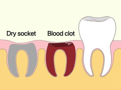 dry socket blood clot tooth extraction vaping