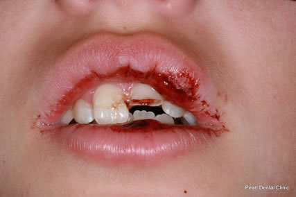 Damage Teeth