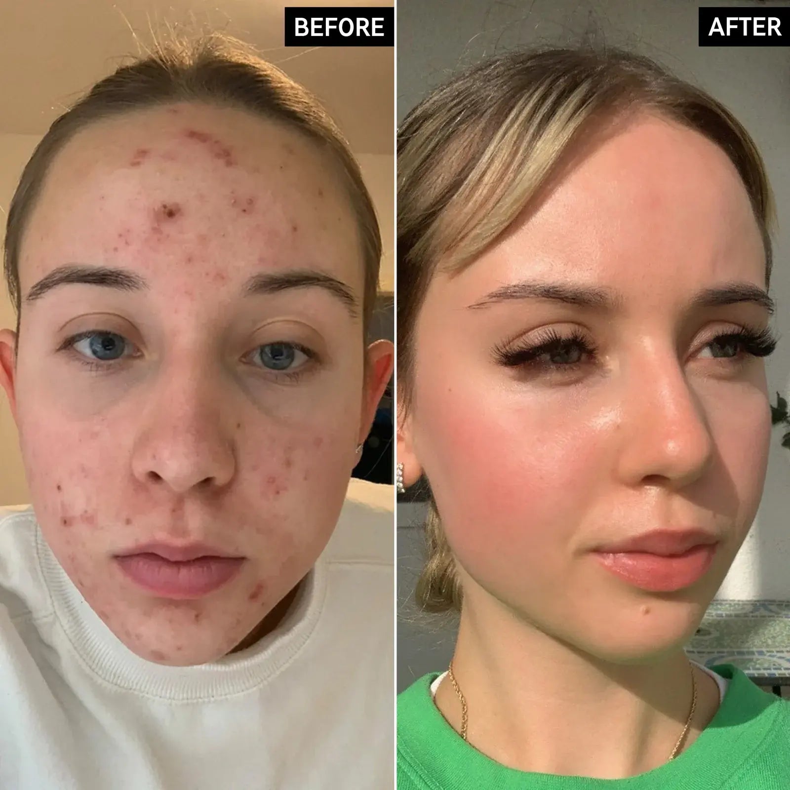 Side-by-side comparison of a person's face before and after skincare treatment.