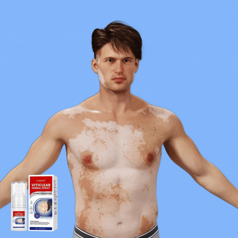 CVREOZ® Vitiligo Herbal Spray