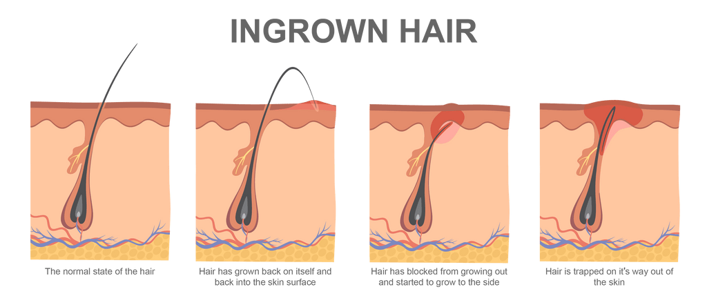 123rf Ingrown Hair Stock Image Edited NS 01 1024x1024 ?v=1603746864