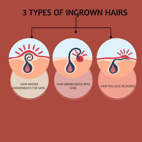 Ingrown_hairs