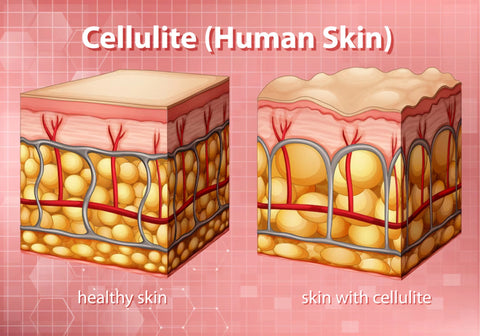 Healthy skin vs skin with cellulite