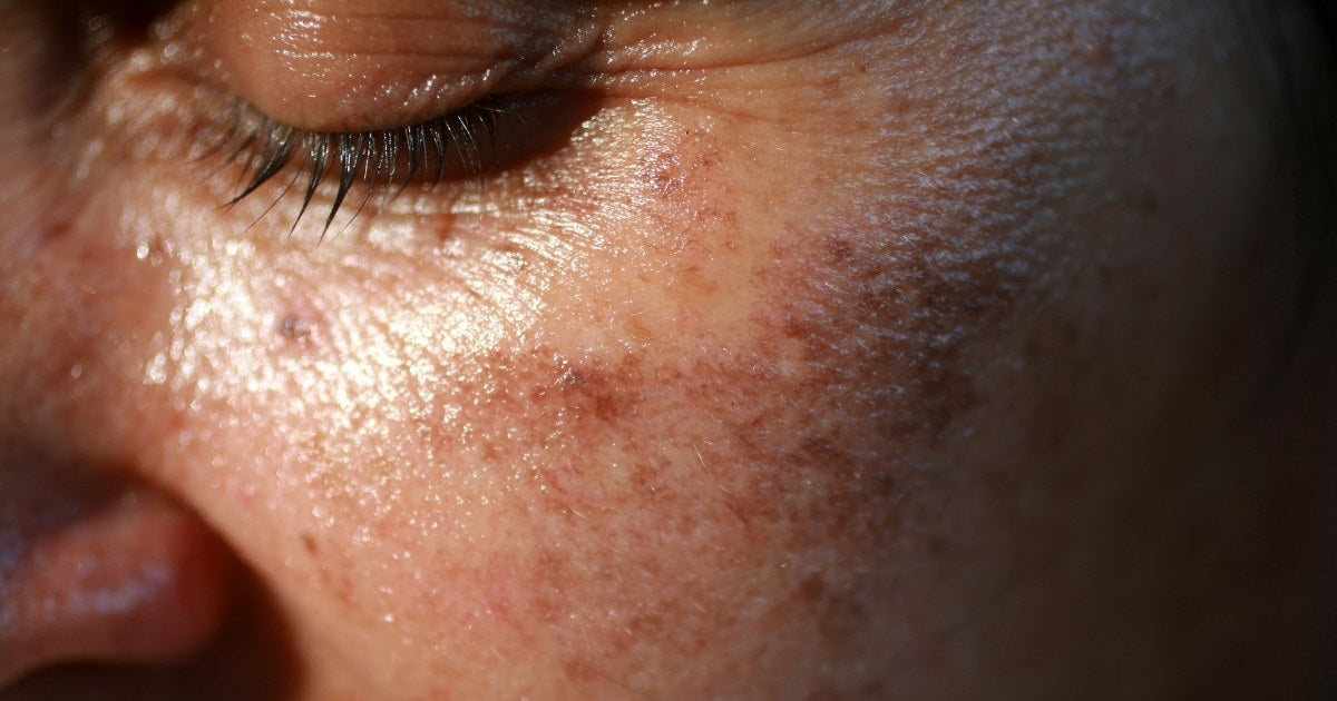 A woman with sunspots on the skin