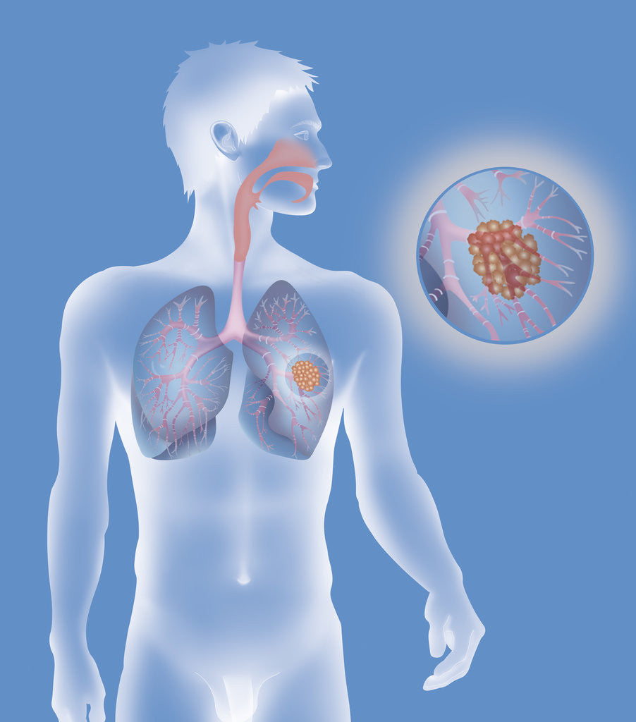 Lung cancer, drawing posters & prints by Corbis