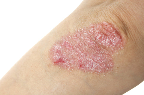 Eczema & Psoriasis: Healing from the inside out