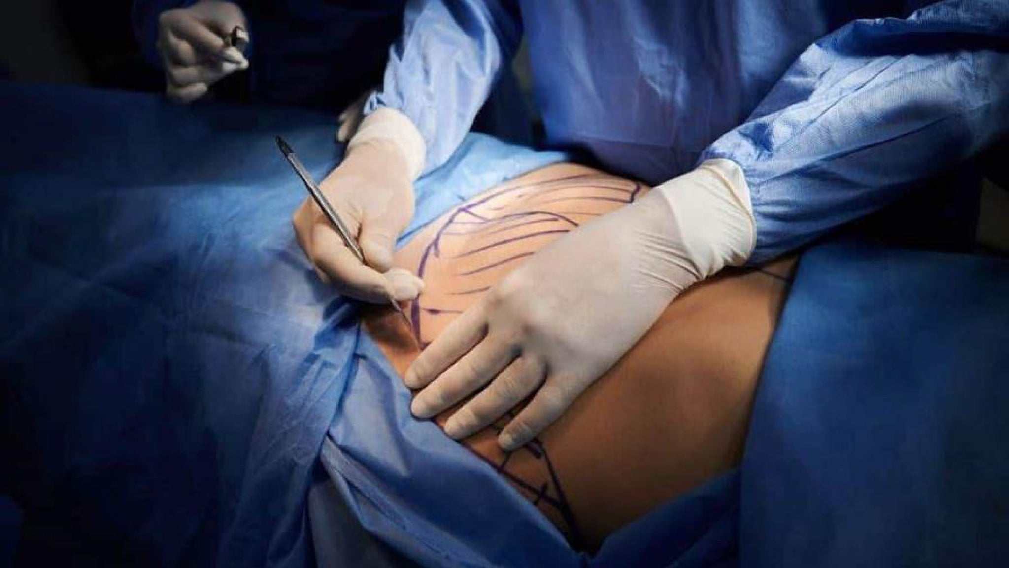 cirujano-plastico-practicando-liposuccion