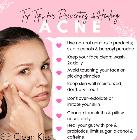 Top tips for preventing and healing acne