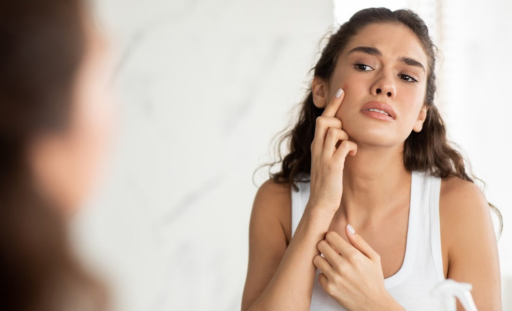 Best Ingredient Combinations for Vitamin C in Acne-Prone Skin