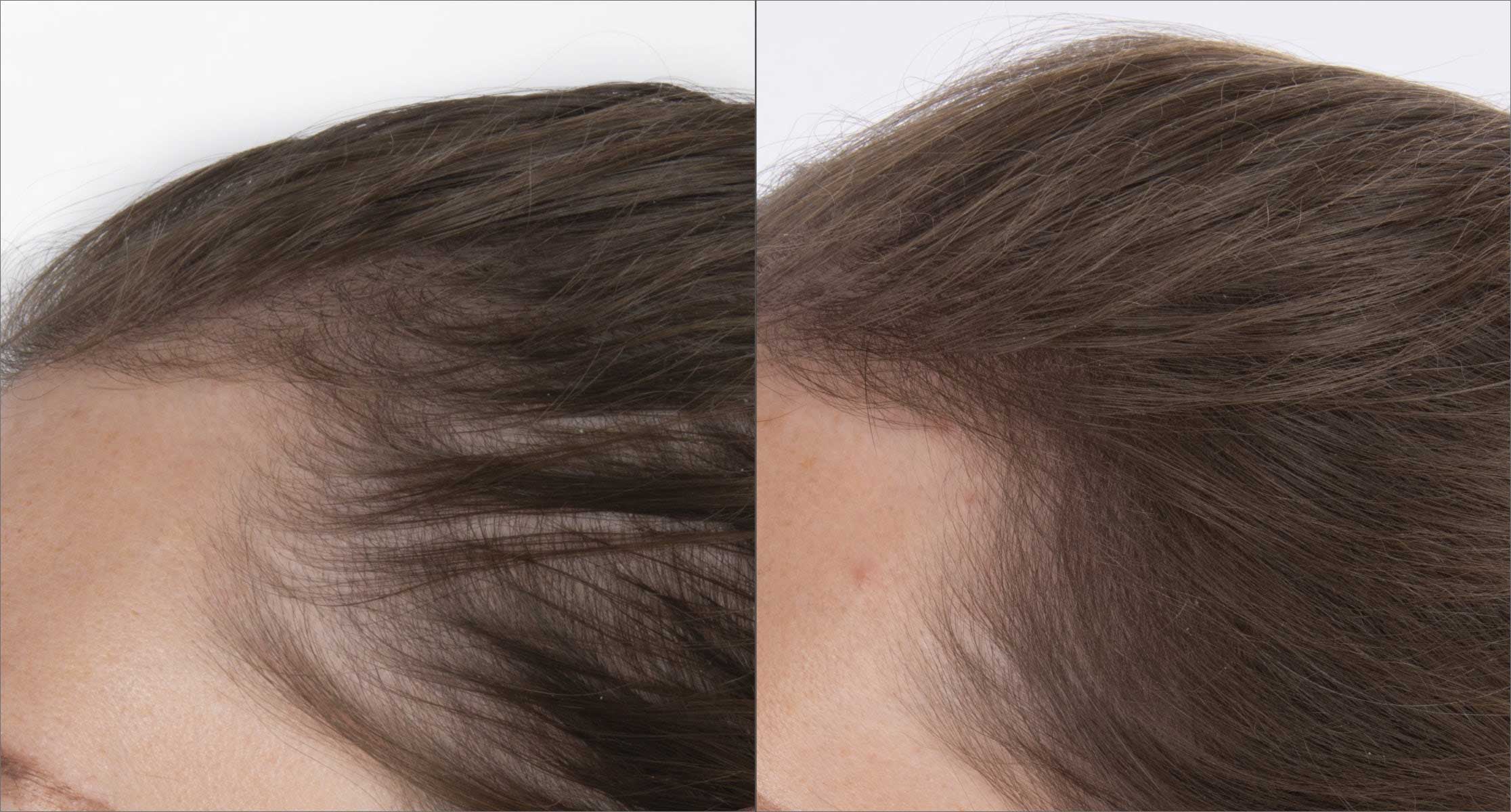 Close up of before and after image of brown haired woman with thin hair and hair growth results over 16 weeks. 