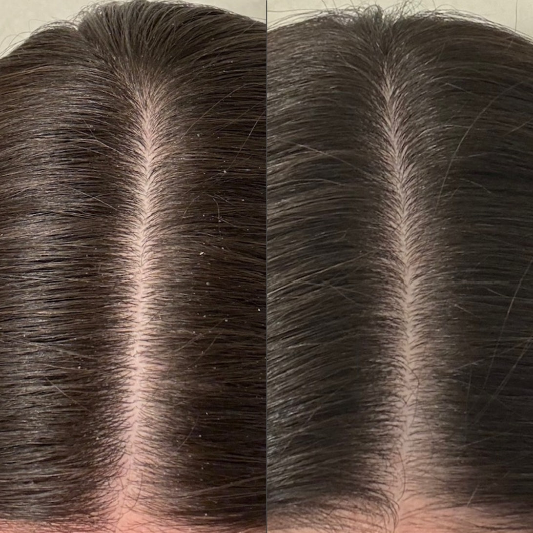 Before and after image of a woman with short, greasy black hair on the left and clean hair on the right. 