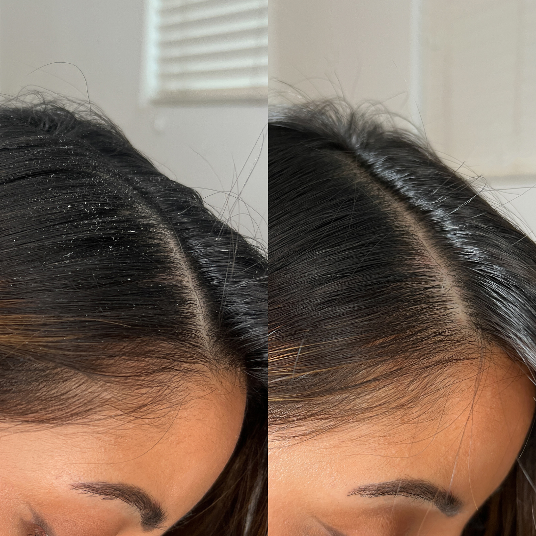 Before and after image of a woman with short, greasy black hair on the left and clean hair on the right. 