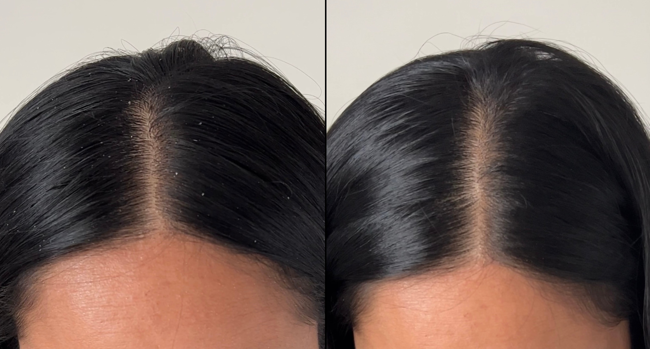 Before and after close-up shot of flakey scalp and a clean scalp. 