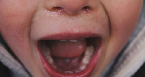 An extreme close up of a young childs face, focusing on the mouth area which is open, exposing the tongue and teeth