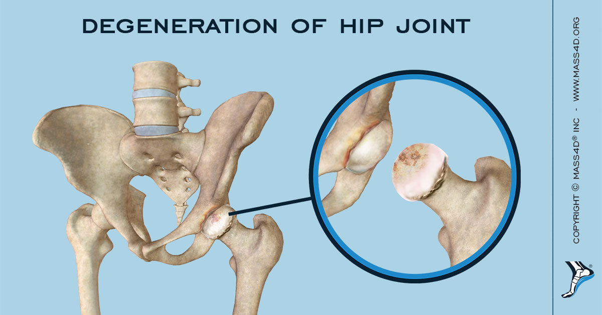 osteophytes hip