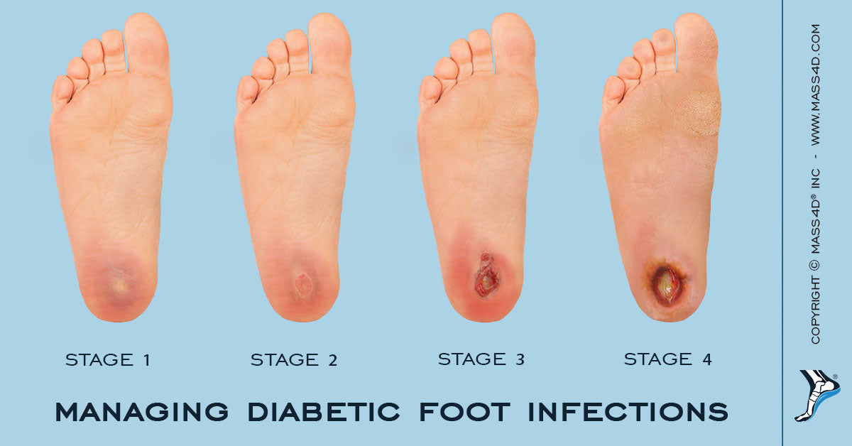How To Manage Diabetic Foot Infections Mass4d® Foot Orthotics