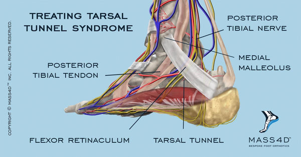 How To Treat Tarsal Tunnel Syndrome - MASS4D® Foot Orthotics