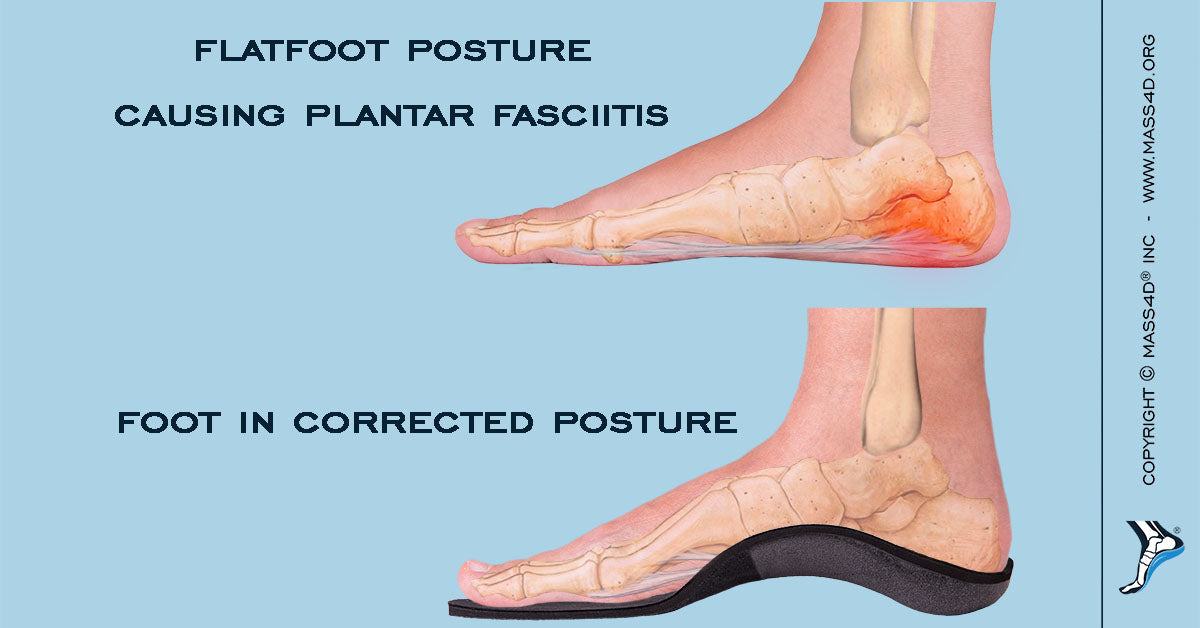 flat feet posture