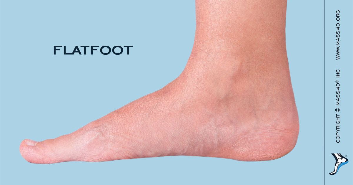 flat feet walking pain