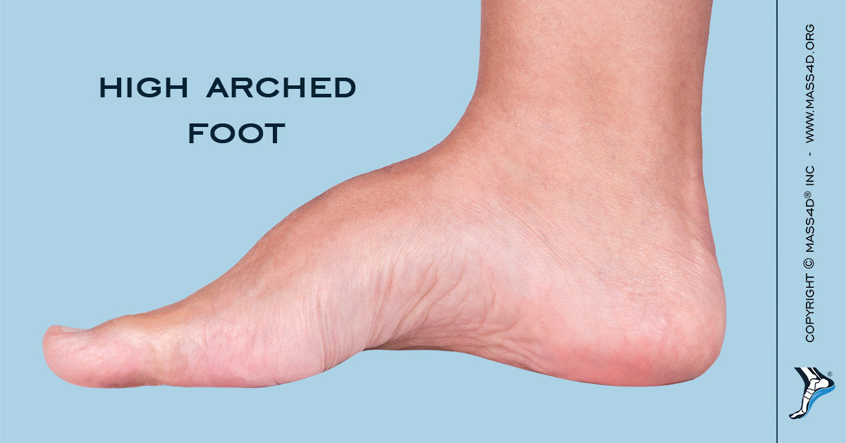 Causes and Symptoms of High Arched Foot 