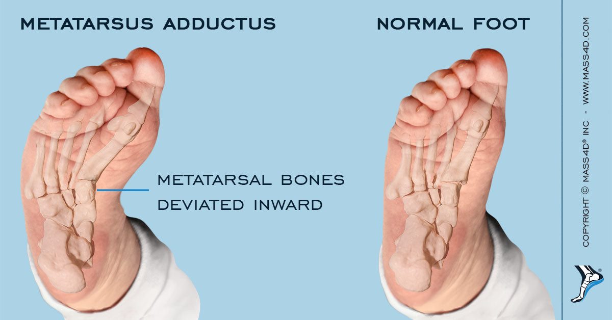 Clinicians Blog By Mass4d® Insoles Tagged Pathology Mass4d® Foot