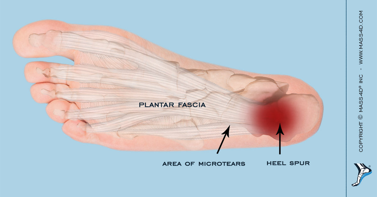 Examining The Cause of Plantar Fasciitis MASS4D® Foot Orthotics