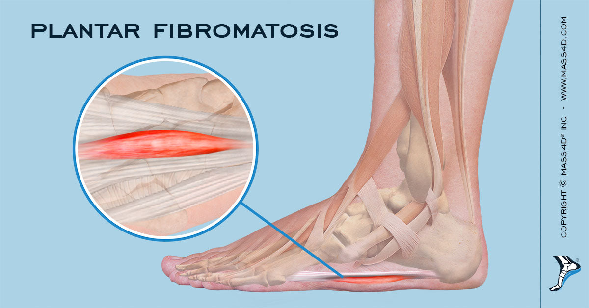 What Is Plantar Fibromatosis? MASS4D® Foot Orthotics