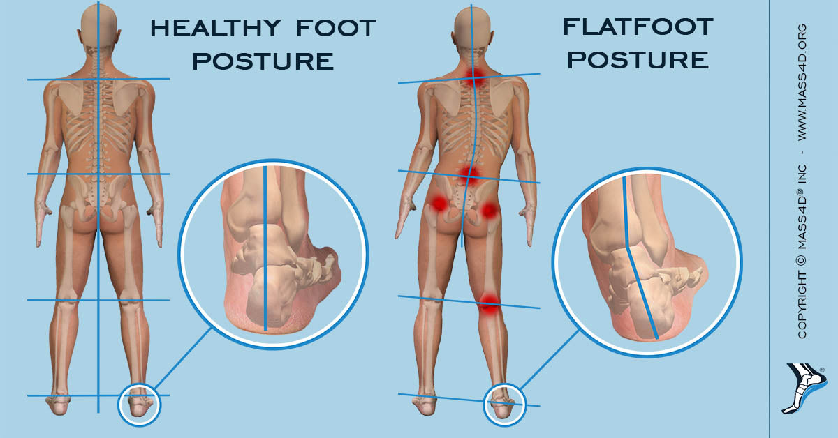 flat feet and poor balance