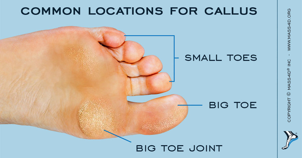 Causes and Symptoms of Callus MASS4D® Insoles MASS4D® Foot Orthotics