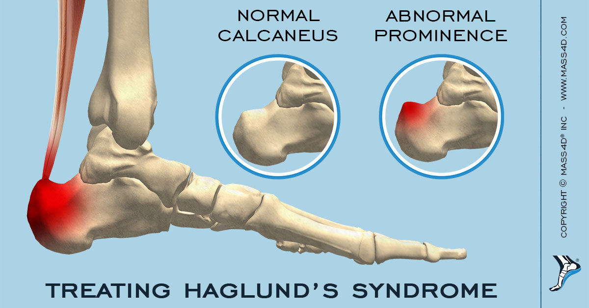 How To Treat Haglund’s Syndrome? MASS4D® Foot Orthotics