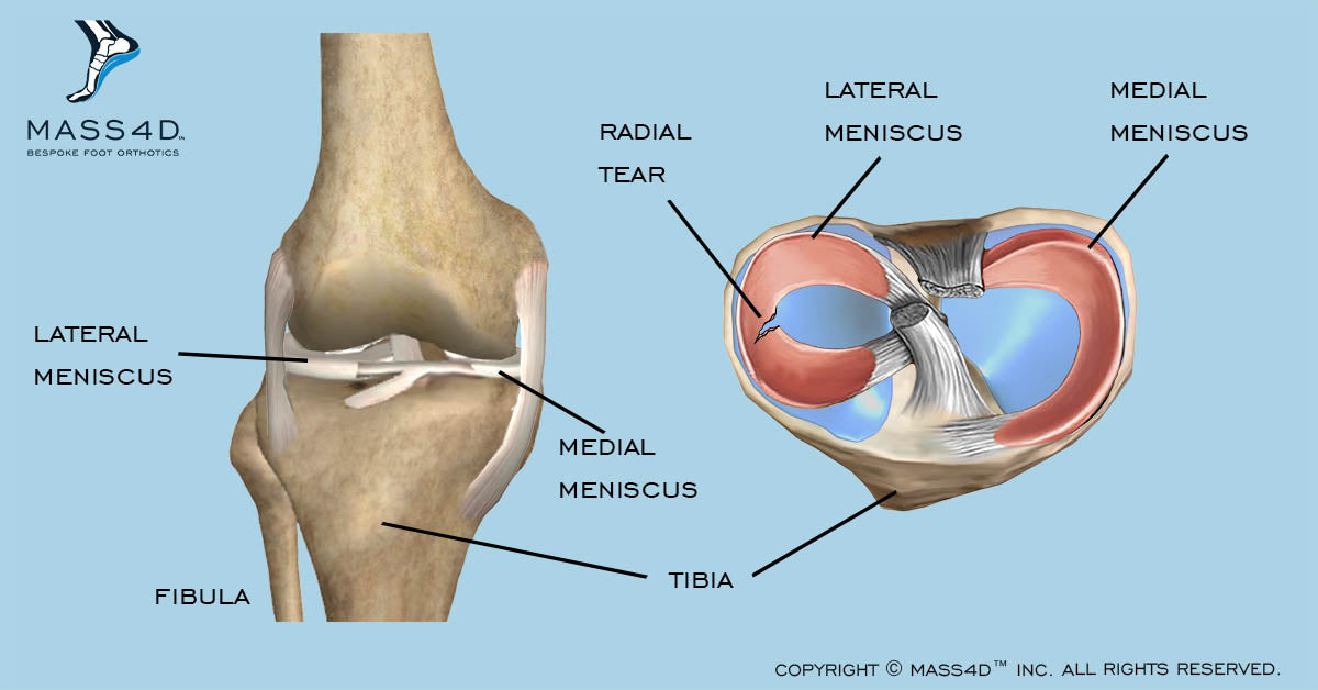 Медиальный и латеральный это. Медиальный мениск коленного сустава. Коленный мениск анатомия. Разрыв мениска коленного сустава. Разрыв медиального мениска коленного сустава.