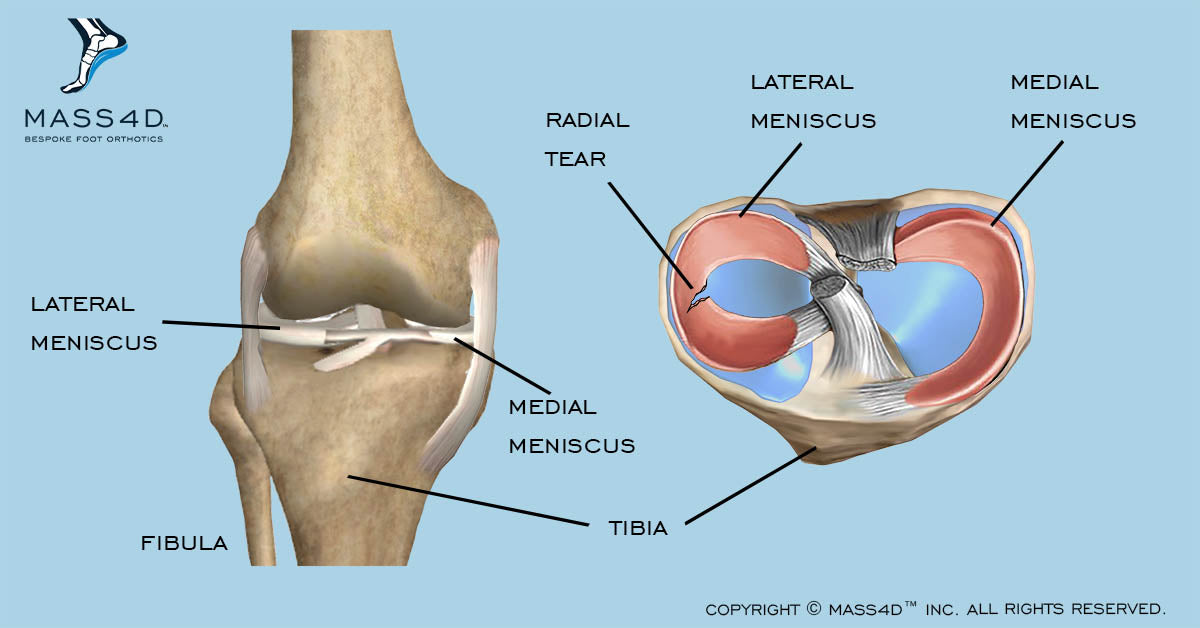 Повреждение мениска. Медиальный мениск коленного сустава. Латеральный и медиальный мениск коленного сустава схема.